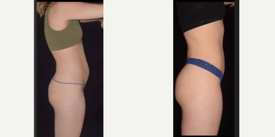 18-24 year old woman treated with Liposuction - The patient is a 23 y.o female who underwent liposuction of flanks and lower abdomen. She has significantly improved contour at 1 month post-op
