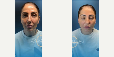 Woman treated with Thread Lift - Woman treated with Thread Lift