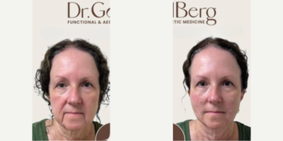 Woman treated with Thread Lift - Woman treated with Thread Lift