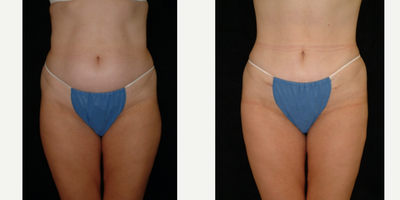 25-34 year old woman treated with Mini Tummy Tuck - Minit TT