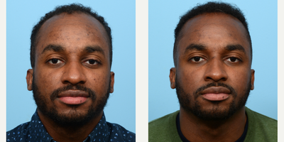 18-24 year old man treated with FUE Hair Transplant, Hair Transplant, Hair Loss Treatment, PRP for Hair Loss, NeoGraft - Dr. Wise performed an FUE hair transplant with 2,210 grafts and one treatment of PRP for this patient to rebuild his hairline and add density. 6 months post-op the patient is thrilled with his results.