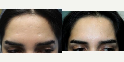 18-24 year old woman treated with Restylane Silk, Scar Removal, Dermal Fillers - 18-24 year old woman treated with Restylane Silk 1 syringe for acne scars.