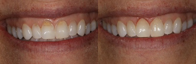 35-44 year old woman treated with Dental Bonding - Acid erosion, patient was self conscious of smile