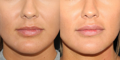 18-24 year old woman treated with Lip Implants - Lip Implants aim to permanently enhance thin lips, by instantly plumping and giving a voluptuous look.