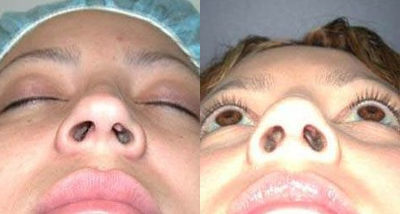 Woman treated with Rhinoplasty - Woman treated with Rhinoplasty