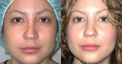 Woman treated with Rhinoplasty - Man treated with Rhinoplasty