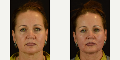 Novathread Lift to the Cheeks and Soften the Corner of the Mouth - Demonstrating results with the Novathreads to lift the cheeks, tighten the corners of the mouth, and soften the jawline. Threads applied to the neck provided significant improvement to the neck bands, tightening that loose skin. Novathreads are dissolvable polydiaxanone (PDO) threads meant for subtle lifting of the skin and usually last up to anywhere inbetween 6-12 months.