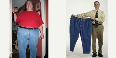 Before & After - Male Treated with Duodenal Switch - Patient underwent Duodenal Switch with a starting weight of 400 lbs.&nbsp;Weight loss of 230 lbs. has been maintained for 11 years.&nbsp;