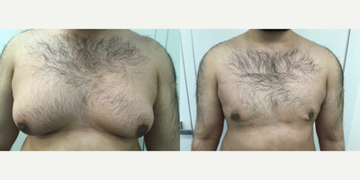 25-34 year old man treated with Tickle Lipo - 23-year-old male underwent Tickle Lipo of the chest.