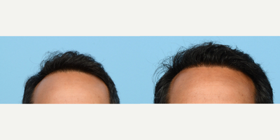 45-54 year old man treated with FUE Hair Transplant, Hair Transplant, Hair Loss Treatment, PRP for Hair Loss, PRP Injections - To strengthen and fill in this patient's hairline, Dr. Wise performed an FUE hair transplant, using 2,525 grafts. In addition, he performed one treatment of PRP therapy to fortify the follicles and accelerate the healing process.