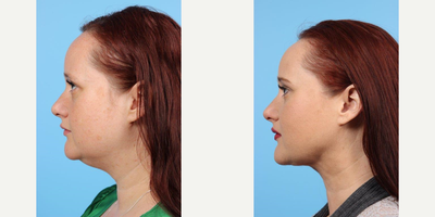 39 year old woman treated with Buccal Fat Removal - A 39 year old woman before and after Liposuction Chin and Neck with Platysmaplasty and removal of Buccal Fat by Andrew T.  Lyos M.D., FACS.
