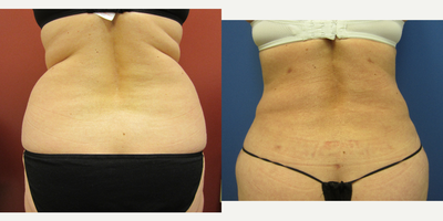 45-54 year old woman treated with Liposuction - tummy tuck with liposuction of abdomen and flanks