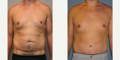18-24 year old man treated with Male Tummy Tuck - This patient is an 18 year old male who lost approximately 100 pounds with diet and exercise. Due to his weight loss, he noted a large amount of excess skin on his abdomen, and to a lesser extent, his chest as well. This skin would not shrink to its original size no matter how much he exercised. As a result, he felt very uncomfortable being shirtless in public.This patient came to my practice in order to improve his abdominal contour. He was not particularly concerned with his chest skin, so we did not address this area surgically.For this patient, I recommended an abdominoplasty (tummy tuck) with liposuction of the flanks to improve his love handle area. I felt he would be unlikely to need internal abdominal wall tightening because he had very strong abdominal muscles, and his problem was mainly due to loose skin and some excess fat.I performed a full tummy tuck with liposuction of the flanks (approximately 350cc of fat was removed from each side. After surgery, he healed very well and was extremely happy with his result. He is comfortable being shirtless in public, and is continuing to lose weight and improve his physique.