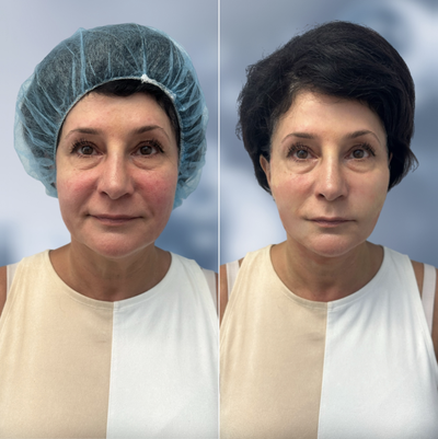 55-64 year old woman treated with Thread Lift, Nonsurgical Facelift, Nonsurgical Neck Lift - The G-Lift procedure offered by Dr. Golberg not only lifts the lower third of the face but also uses bio-stimulating agents to enhance the upper areas. This comprehensive method ensures a balanced and rejuvenated appearance. In just one hour, the G-Lift can deliver remarkable results, combining thread lifts with bio-stimulation for a youthful transformation.