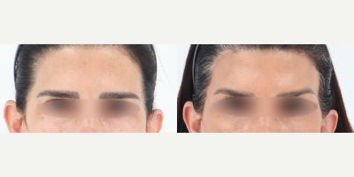 55-64 year old woman treated with Brow Lift - Women in her mid 50's before and after brow lift by Dr. Madnani