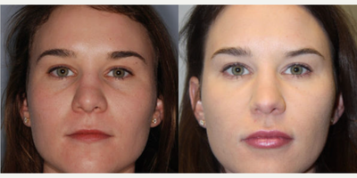 Woman treated with Lip Implants - Woman treated with Lip Implants