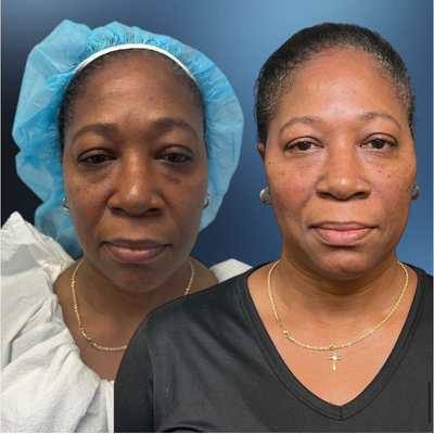 55-64 year old woman treated with Nonsurgical Facelift - In this transformative before-and-after visual, we highlight the stunning results of a G-lift procedure performed on a 56-year-old woman. The G-lift, known for its ability to rejuvenate the facial contours non-surgically, has beautifully lifted and tightened her skin, restoring a youthful vitality to her overall appearance