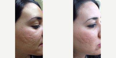 Woman treated with SkinPen - Woman treated with SkinPen Microneedling for treatment of acne scars