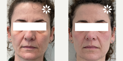 55-64 year old woman treated with ProFractional Laser - ProFractional Laser treatment on patient's cheeks, performed by Suzanne.