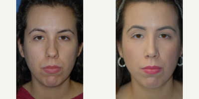 Woman treated with Rhinoplasty - Woman treated with Rhinoplasty through reshaping of hernasal tip and bridge.