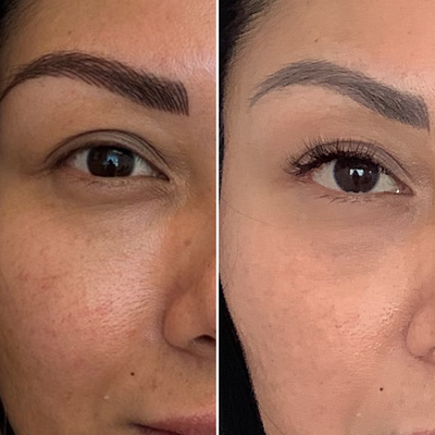 25-34 year old woman treated with Plasma Pen - Plasma Pen non-surgical facial lifting and tightening.