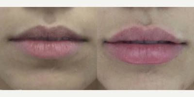 18-24 year old woman treated with Restylane - This 20 year old female patient desired fuller lips. So, Dr. Katzen used Restylane filler to achieve a plump lip augmentation. Restylane is a FDA-approved filler which can be used throughout the body. It is an excellent way to correct deep nasolabial folds, lip augmentation and cheek augmentation.