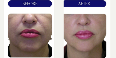 55-64 year old woman treated with Thread Lift, MINT threadlift - mint threadlift