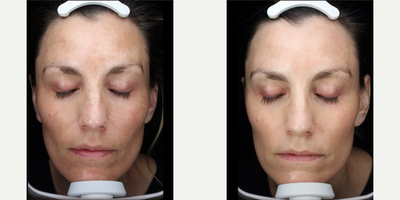 35-44 year old woman treated with Clear and Brilliant - Clear and Brilliant series of 3 treatments