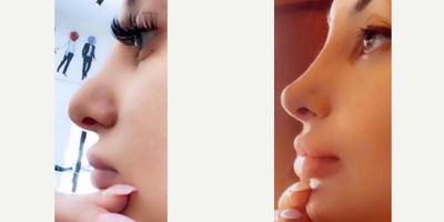 18-24 year old woman treated with Rhinoplasty - Rhinoplasty!! 1 week post op!