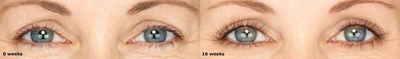 25-34 year old woman treated with Latisse - Latisse