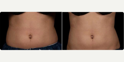 Woman treated with truFlex - Woman treated with Secret RF.