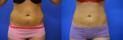 23 y/o female s/p SmartLipo treatment to abdomen/flanks - 23 y/o female after SmartLipo treatment to her abdomen and flanks. A total of 1350 cc was removed in total.