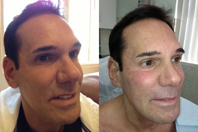 Ulthera and Fillers- before and after - 
	Ultherapy and Radiesse filler- Lifting of the face and neck without cutting
