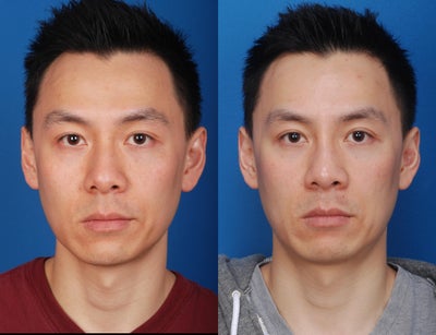 Asian Rhinoplasty - 
	The patient desired augmentation along the bridge of the nose, refining of the nasal tip, and the use of non-synthetic implant materials. The patient underwent rhinoplasty with the use of native cartilage and fascia to eliminate any future concern of implant rejection or infection.
