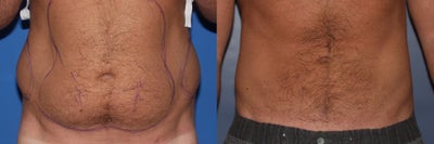 Vaser Liposelect, Male - 
	Vaser Liposelect, Male
