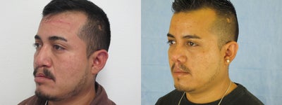 Secondary Cleft Lip and Cleft Rhinoplasty Revision - 
	Secondary Bilateral Cleft Lip Repair, With Auto-Augmentation of Lip and Cleft Nose Rhinoplasty
