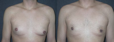 22 Year Old Male Underwent Male Breast Reduction - 	This 22 year old male complained that his breasts were too large and feminine. His chest is flatter and more masculine after power-assisted liposuction for his gynecomastia.