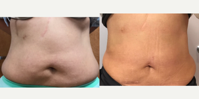 45-54 year old woman treated with Laser Liposuction - Liposuction with Tickle Lipo and J-Plasma