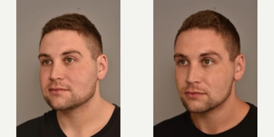 Man treated with Liposuction, Buccal Fat Removal - Check out our patient 3 months post-op, Neck liposuction and buccal fat removal! We were able to remove 110CCs of fat from the neck/ chin and 2CCs of buccal fat on each cheek.