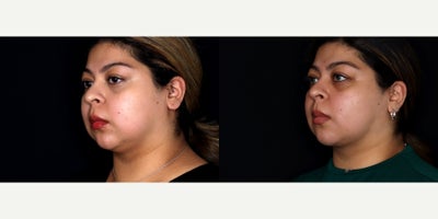 23 year old woman treated with Liposuction, PrecisionTx, Facial Fat Transfer to chin - 23 year old female treated with liposuction to face and submental neck (Precision tx) and fat transfer to the chin. Photos depict before and 3 months after surgery