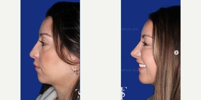 35-44 year old woman treated with Revision Rhinoplasty, Chin Implant - 35-44 year old woman treated with Revision Rhinoplasty, Chin Implant