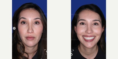 25-34 year old woman treated with Revision Rhinoplasty - 25-34 year old woman treated with Revision Rhinoplasty