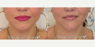 35-44 year old transgender woman treated with Facial Feminization Surgery - 35-44 year old transgender woman treated with Facial Feminization Surgery