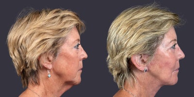 65-74 year old woman treated with Facelift, Eyelid Surgery, CO2 Laser, Skin Rejuvenation, Lower Facelift, Neck Lift, SMAS Faceli - This 68 year old woman is 5'2 and 129 pounds. She presented requesting facial rejuvenation. She had a deep plane - SMAS facelift and neck lift, lower eyelid blepharoplasty, corner of the mouth lift, and central face skin rejuvenation with CO2 laser resurfacing.
