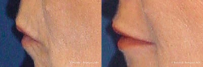 Woman treated with Lip Augmentation - Woman treated with Lip Augmentation using round Advanta implants in both upper and lower lip. Patient was unhappy with her thin lips and had noticed that they had thinned out as she became older. Additionally she wanted to get rid of the wrinkles around her lips.