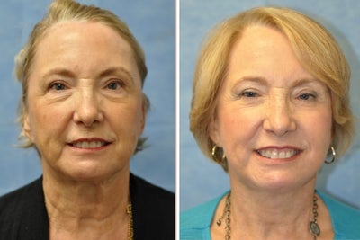 65 Year Old Female Treated for Unacceptable Appearance of Face - 
	Procedure: Facelift
