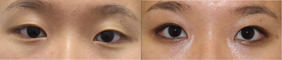 Double eyelid surgery for crease asymmetry - She underwent conservative double eyelid surgery to improve her eyelid crease symmetry while keeping natural-looking eyes.