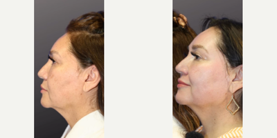 Chemical Peel - Woman treated with Chemical Peel