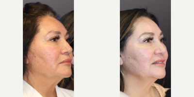 Chemical Peel - Woman treated with Chemical Peel