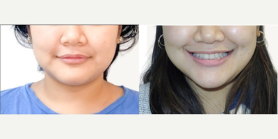 Woman treated with Jaw Surgery - Woman treated with Jaw Surgery.